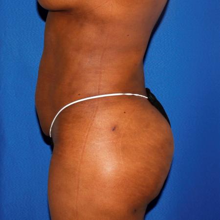 After image 3 Case #109146 - Liposuction and Fat Transfer to Buttock
