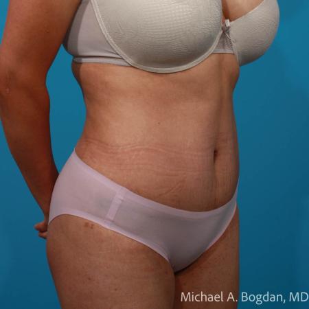 After image 2 Case #109036 - Abdominoplasty