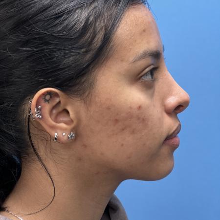 After image 3 Case #109041 - 21 year old - Rhinoplasty 
