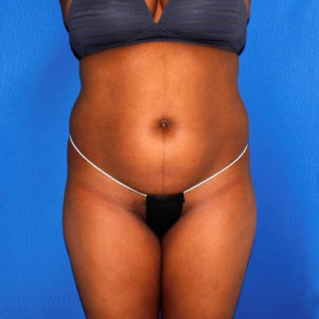 Before image 1 Case #109146 - Liposuction and Fat Transfer to Buttock