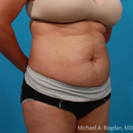 Before image 2 Case #109036 - Abdominoplasty