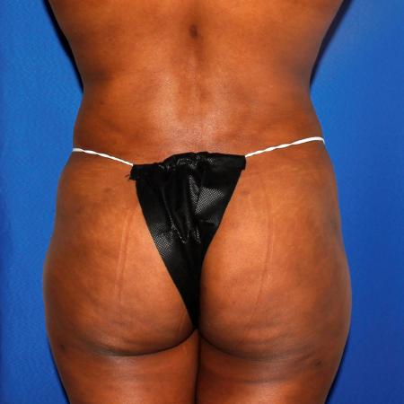 After image 4 Case #109146 - Liposuction and Fat Transfer to Buttock