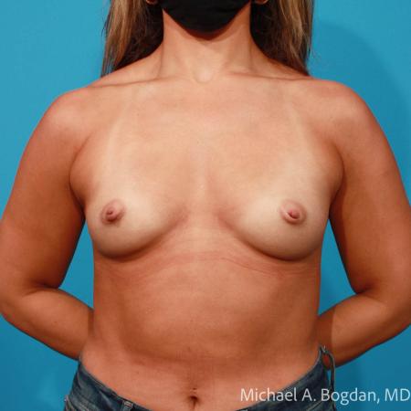Before image 1 Case #109031 - Breast Augmentation