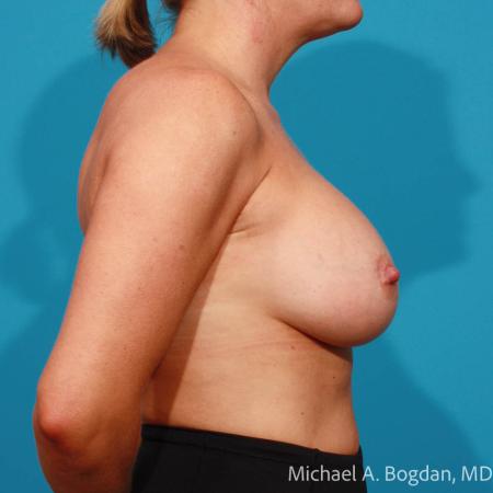 After image 3 Case #109021 - Breast Augmentation