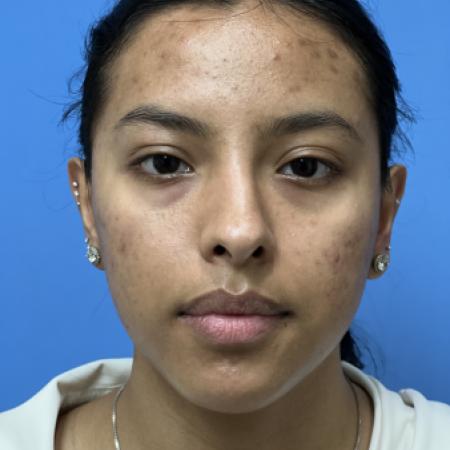 Before image 1 Case #109041 - 21 year old - Rhinoplasty 