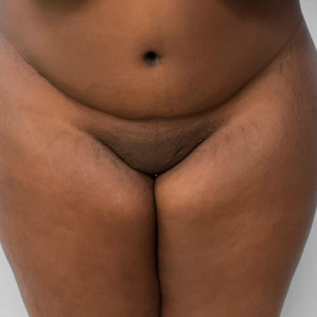 After image 1 Case #109136 - BBL Fat Transfer