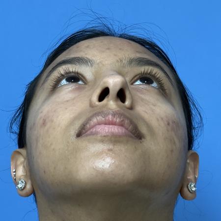 Before image 4 Case #109041 - 21 year old - Rhinoplasty 