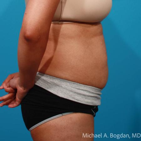 Before image 3 Case #109036 - Abdominoplasty