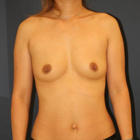 Before image 1 Case #109256 - Breast Augmentation
