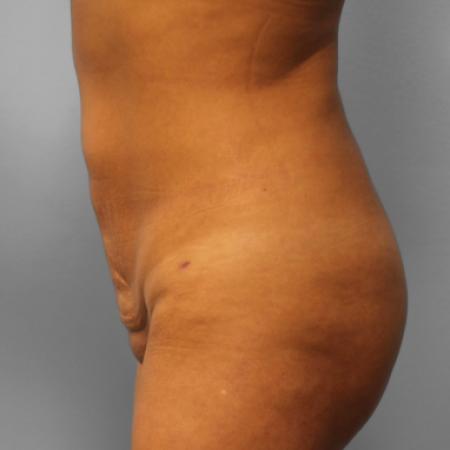 After image 2 Case #109186 - Liposuction & BBL