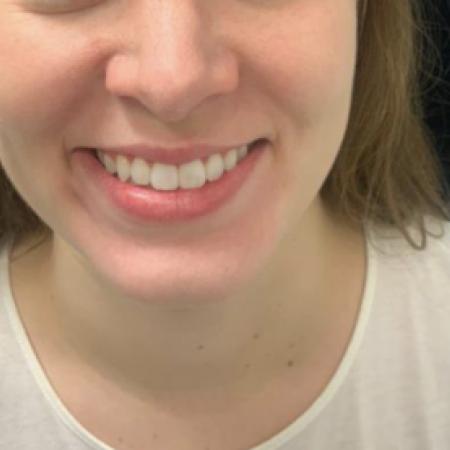 Before image 1 Case #109391 - Restylane Kysse Lip Filler