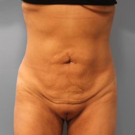 After image 1 Case #109186 - Liposuction & BBL