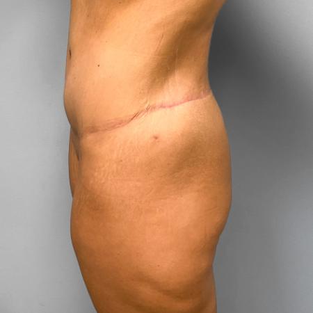 After image 2 Case #109181 - Body Lift