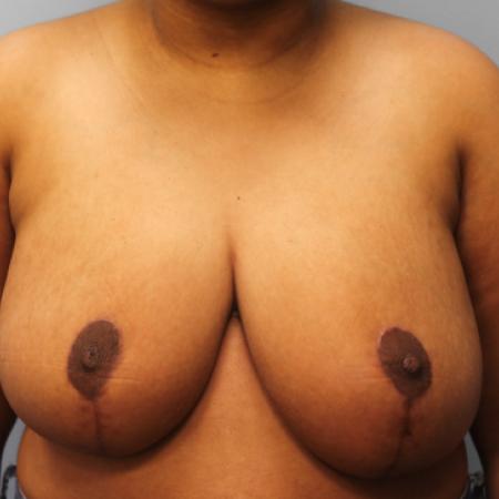 After image 1 Case #109176 - Breast Reduction