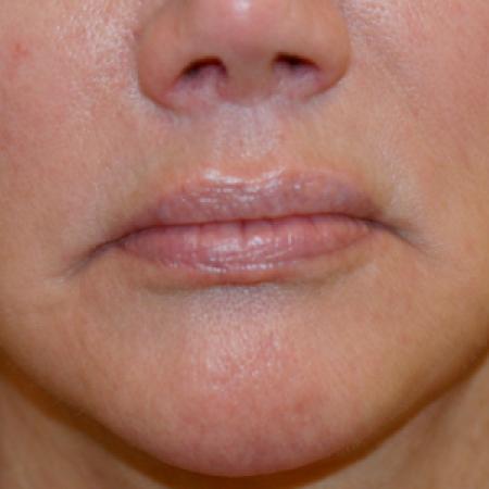 Before image 1 Case #109251 - Female Corner Lip Lift