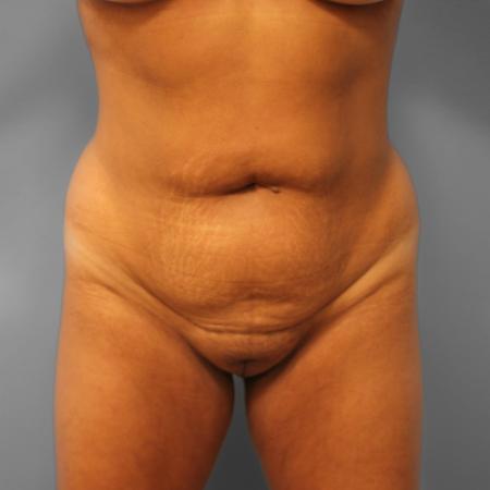 Before image 1 Case #109186 - Liposuction & BBL