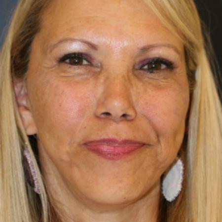 After image 1 Case #109266 - Facelift/Necklift