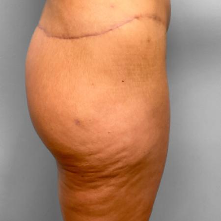 After image 3 Case #109276 - Butt Lift