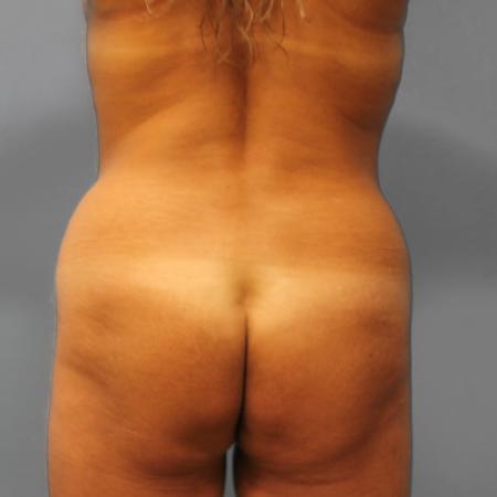 Before image 3 Case #109186 - Liposuction & BBL