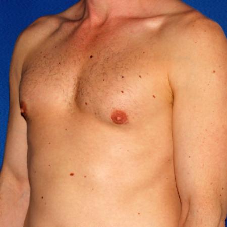 After image 2 Case #109226 - Gynecomasta Correction