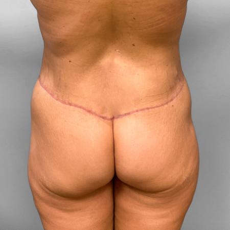 After image 1 Case #109181 - Body Lift