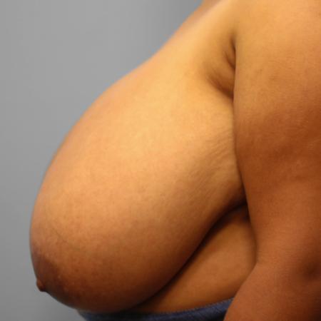Before image 3 Case #109176 - Breast Reduction