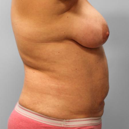 After image 3 Case #109166 - SmartLipo
