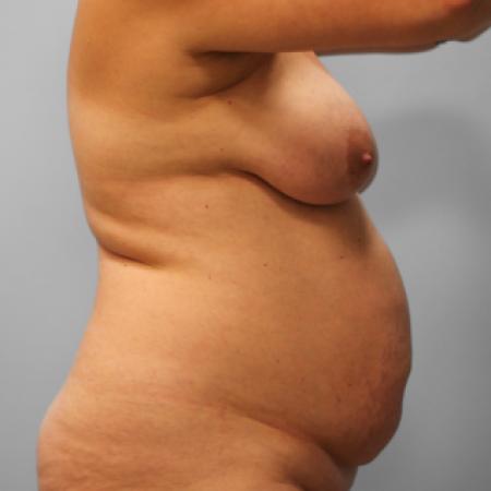 Before image 3 Case #109166 - SmartLipo