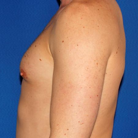 After image 3 Case #109226 - Gynecomasta Correction