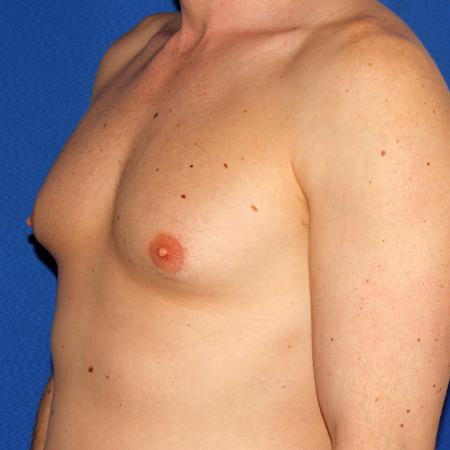 Before image 2 Case #109226 - Gynecomasta Correction