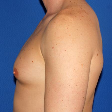 Before image 3 Case #109226 - Gynecomasta Correction