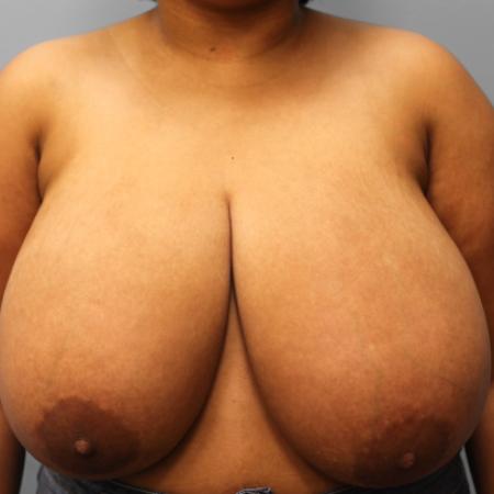 Before image 1 Case #109176 - Breast Reduction