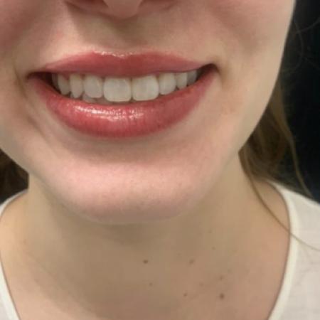 After image 1 Case #109391 - Restylane Kysse Lip Filler