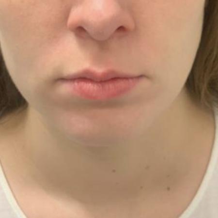 Before image 4 Case #109391 - Restylane Kysse Lip Filler