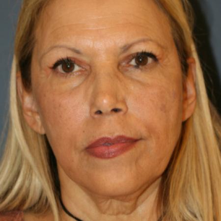 Before image 1 Case #109266 - Facelift/Necklift