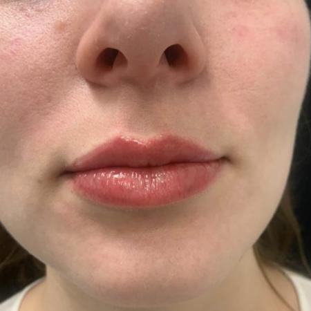 After image 4 Case #109391 - Restylane Kysse Lip Filler