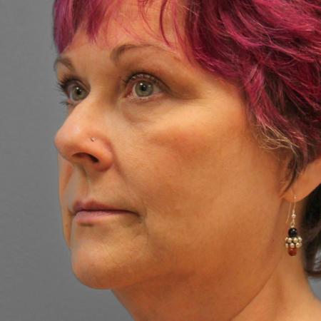 Before image 2 Case #109191 - Facelift & Upper Bleph