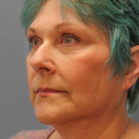 After image 2 Case #109191 - Facelift & Upper Bleph