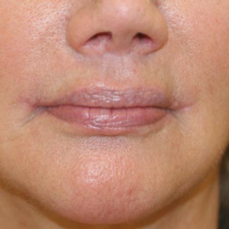 After image 1 Case #109251 - Female Corner Lip Lift