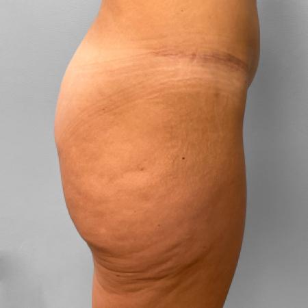 Before image 3 Case #109276 - Butt Lift