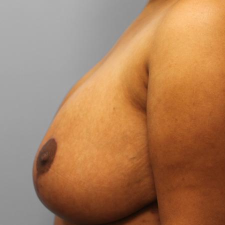 After image 3 Case #109176 - Breast Reduction
