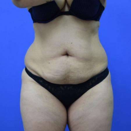 Before image 1 Case #109506 - Drainless Tummy Tuck
