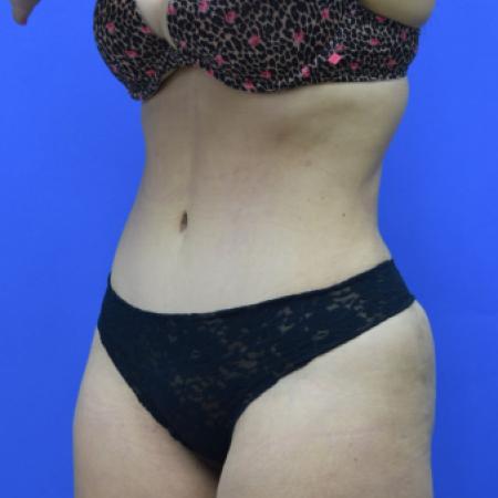 After image 2 Case #109506 - Drainless Tummy Tuck