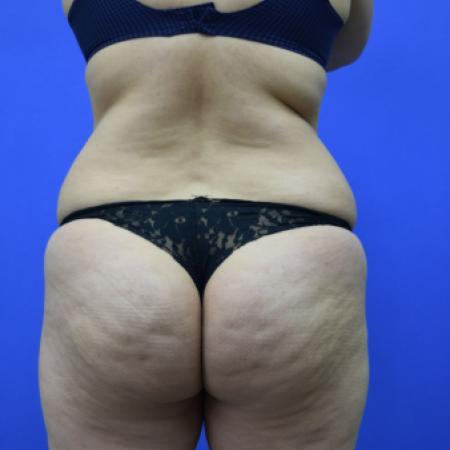 Before image 5 Case #109506 - Drainless Tummy Tuck
