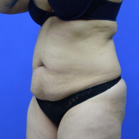 Before image 2 Case #109506 - Drainless Tummy Tuck