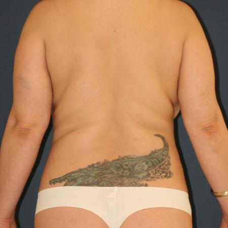Before image 2 Case #109546 - Female Liposuction (SAL) to Waist and Flanks