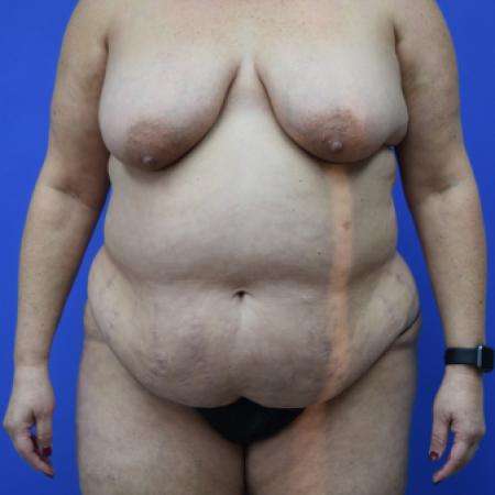 Before image 1 Case #109496 - Mommy makeover