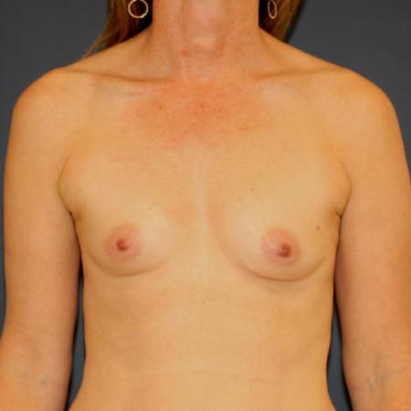 Before image 1 Case #109536 - Breast Augmentation