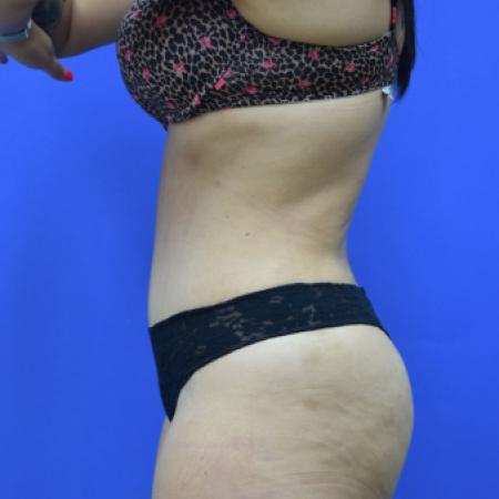 After image 3 Case #109506 - Drainless Tummy Tuck