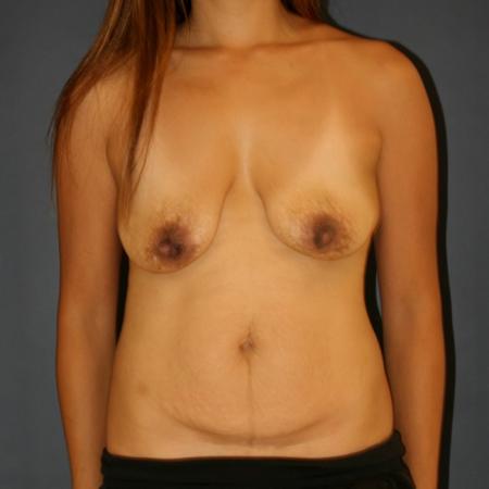 Before image 1 Case #109531 - Mommy Makeover